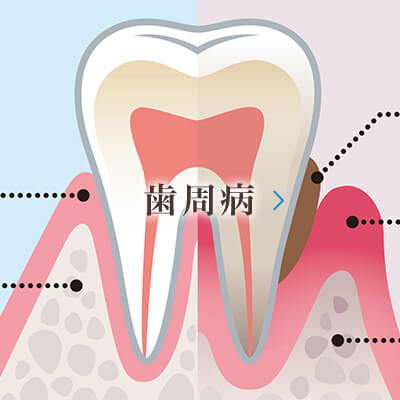 歯周病|八戸ノ里のしろくま歯科