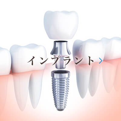 インプラント|八戸ノ里のしろくま歯科