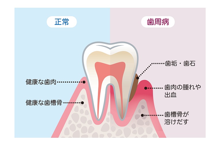 歯周病とは